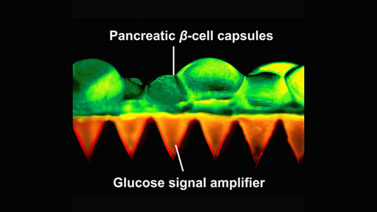 Painless patch, insulin-producing beta cells control diabetes