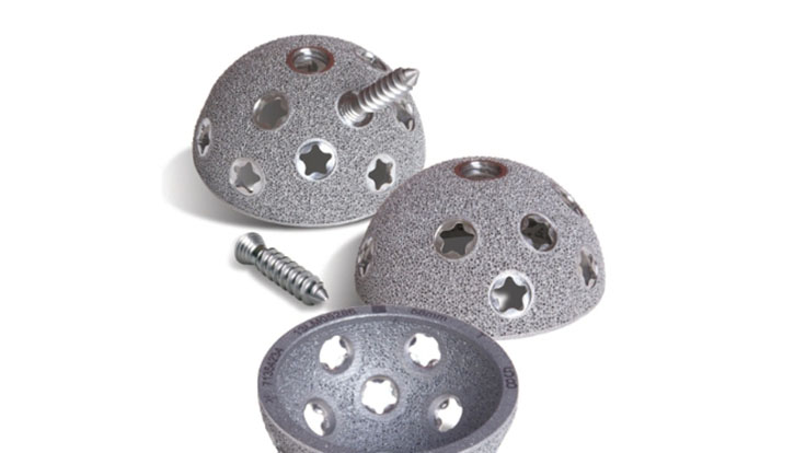 3D-printed titanium hip implant