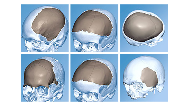 DePuy Synthes, Materialise, 3D-printed titanium cranio-facial implants