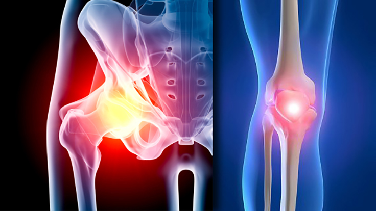 Hip, knee orthopedic surgical implants market to $33B by 2022