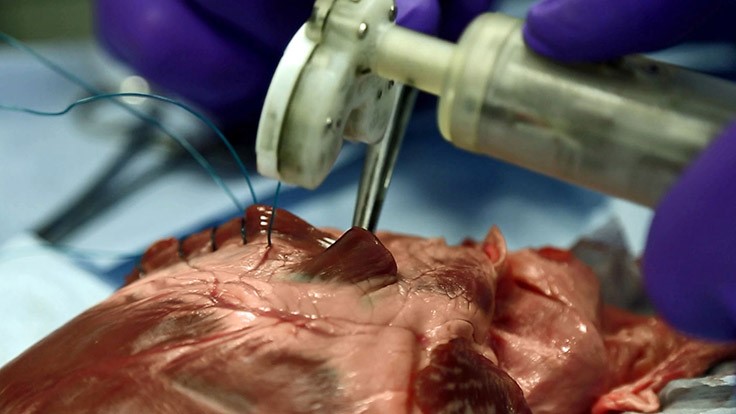 3D printing parts in medical suturing device