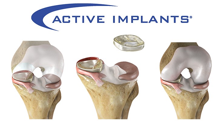 Breakthrough Device Designation for NUsurface meniscus implant