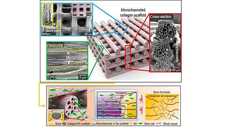 Surface, cross-sectional optical/SEM images showing the uniaxially aligned surface patterns and microchannels within the struts of the fabricated collagen scaffolds. A schematic showing the osteogenesis and angiogenesis of the fabrication of mineralized, microchanneled collagen scaffold.