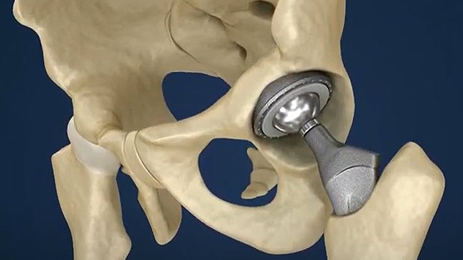 An orthopedic hip implant shown with a femoral ball