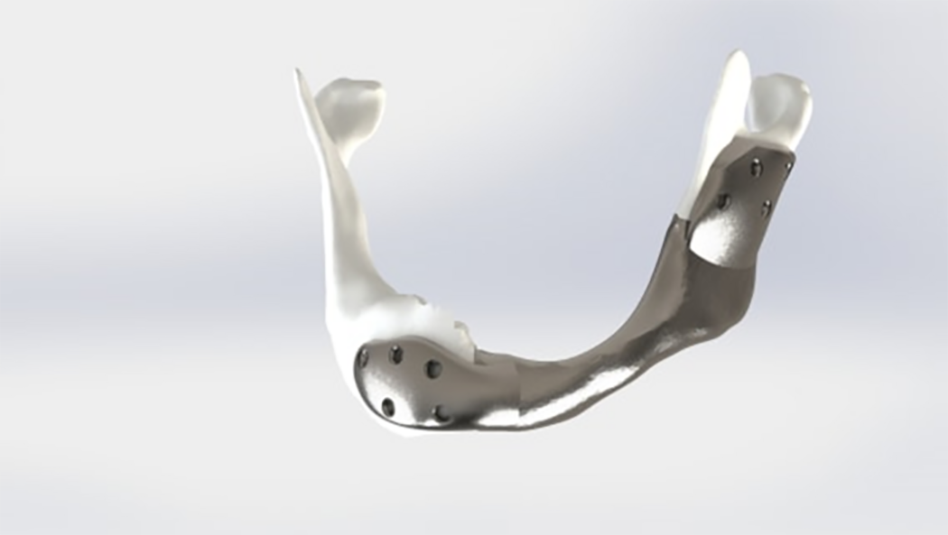 Custom 3D-printed titanium lower jaw