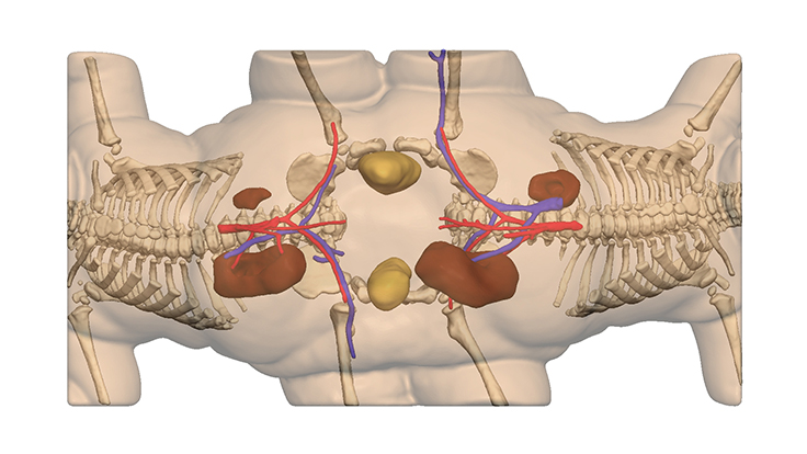 A 3D model of the conjoined twins’ anatomy as seen underneath transparent skin.