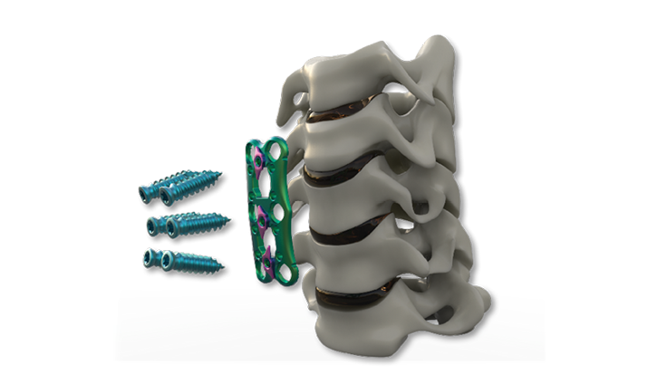 Cervical cage machining: Peek to 3D-printed titanium