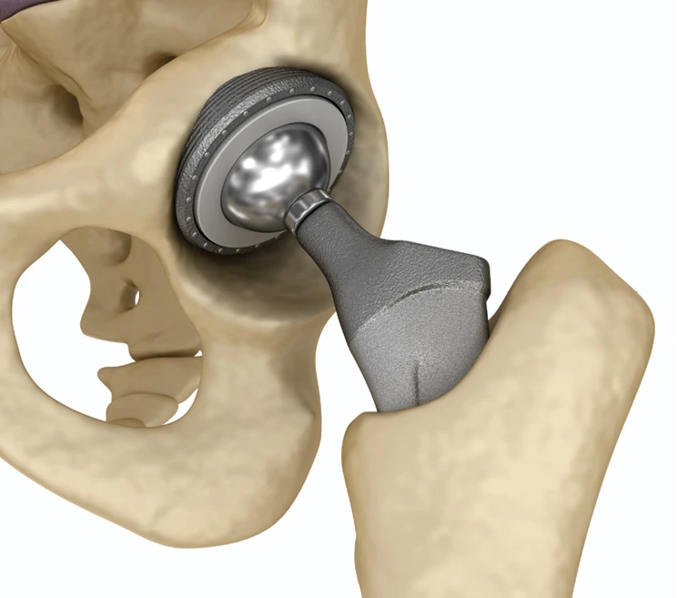 Hip replacement