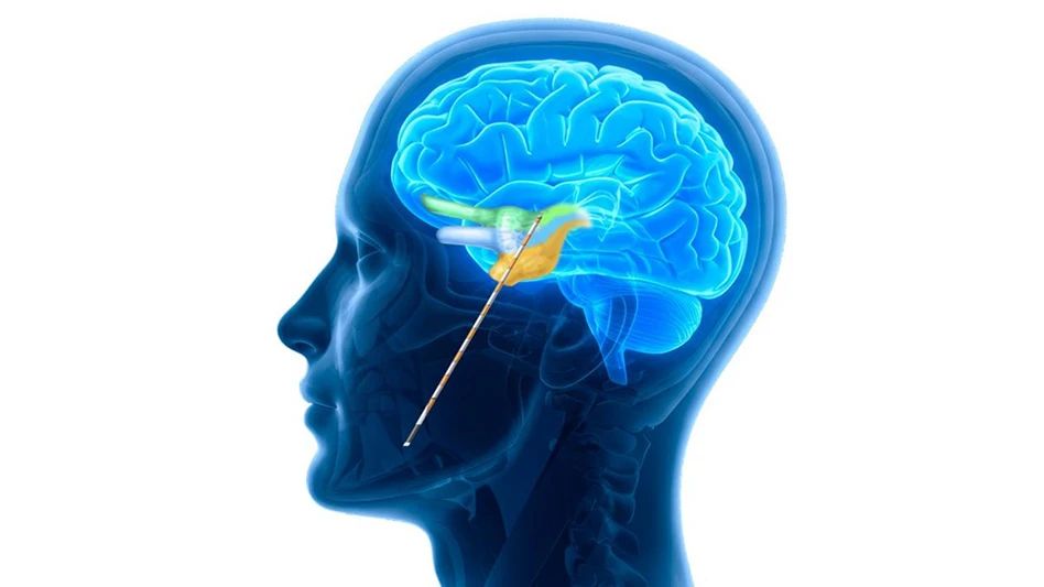 A graphic showing a minimally invasive brain treatment